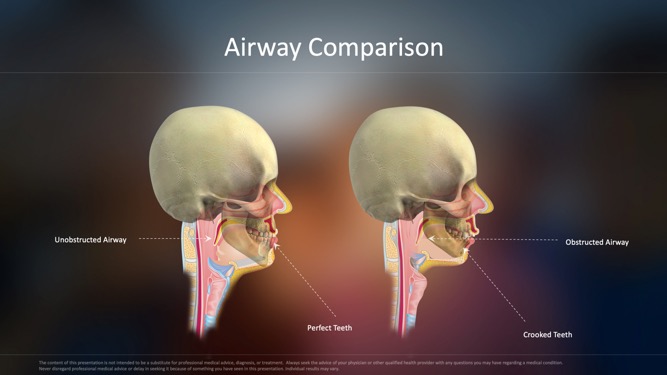 Airway Comparison dental