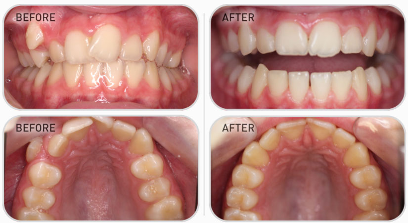 bent wire system teeth