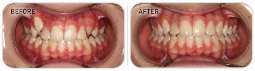 Developing Permanent Dentition teeth