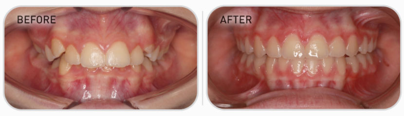 mixed dentition teeth