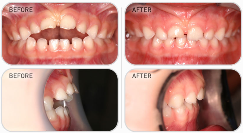 primary dentition teeth