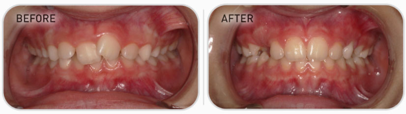mixed dentition teeth