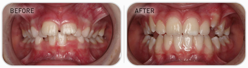 mixed dentition teeth