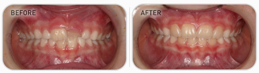 mixed dentition teeth