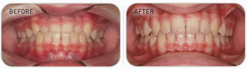 mixed dentition teeth