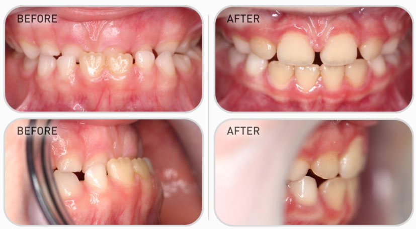 primary dentition teeth