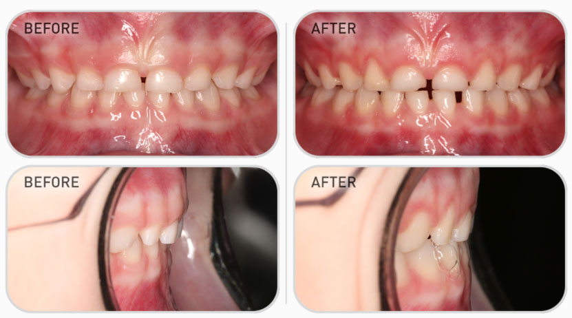 primary dentition teeth