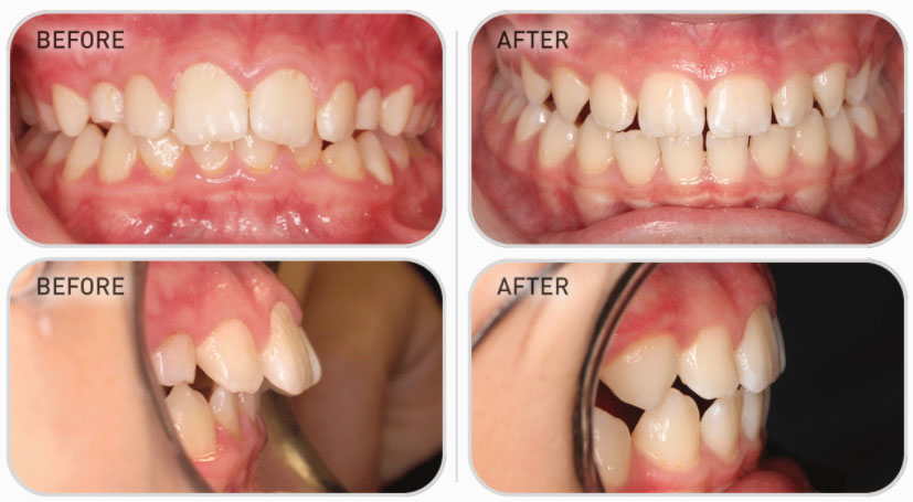 bent wire system teeth