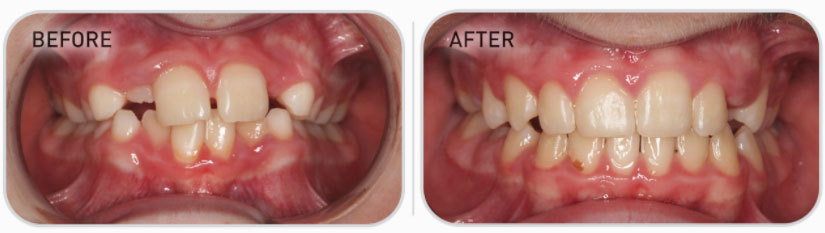 mixed dentition teeth