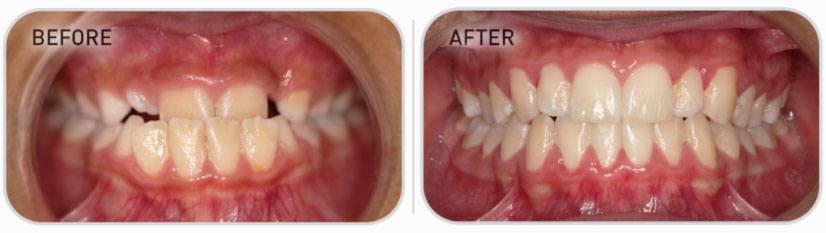 mixed dentition teeth