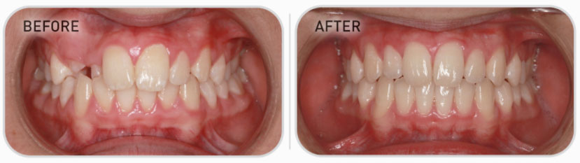 mixed dentition teeth