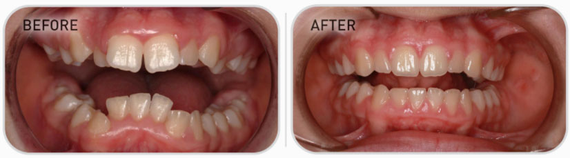 mixed dentition teeth