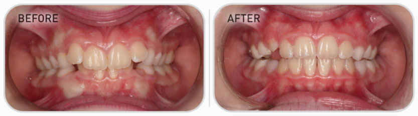 mixed dentition teeth