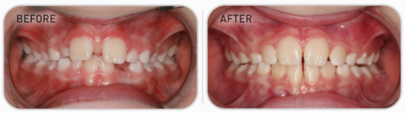 mixed dentition teeth