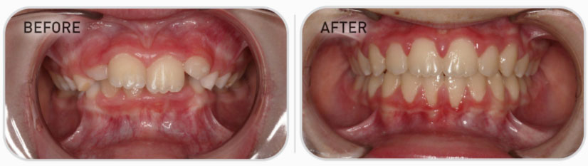 mixed dentition teeth