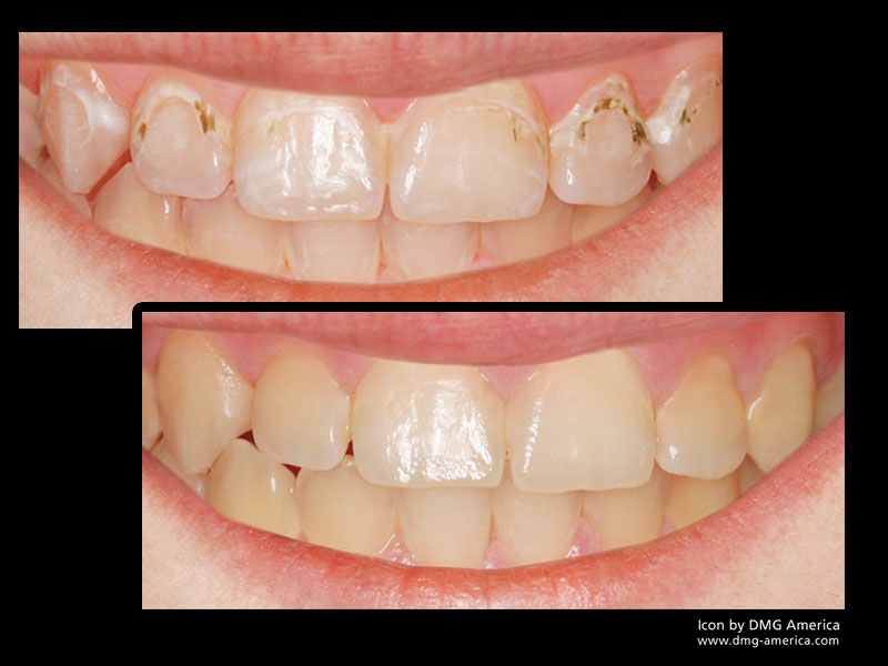 infiltration white spots teeth