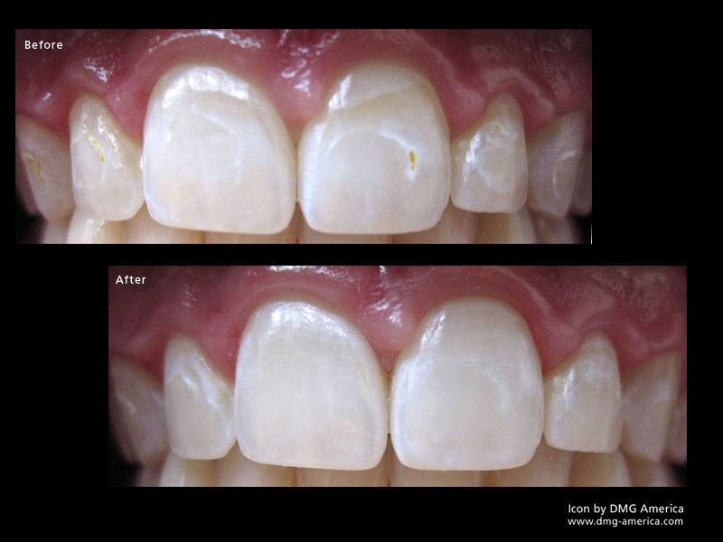 infiltration white spots teeth