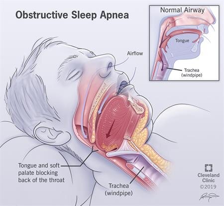 obstructive sleep apnea
